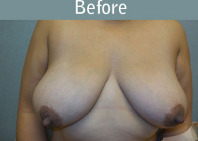 Milwaukee Plastic Surgery - Breast Lift - 22-1