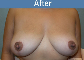 Milwaukee Plastic Surgery - Breast Lift - 22-2