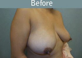 Milwaukee Plastic Surgery - Breast Lift - 22-3