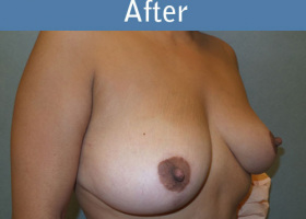 Milwaukee Plastic Surgery - Breast Lift - 22-4