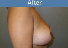 Milwaukee Plastic Surgery - Breast Lift - 22-6