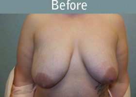 Milwaukee Plastic Surgery - Breast Lift - 23-1