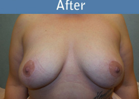 Milwaukee Plastic Surgery - Breast Lift - 23-2