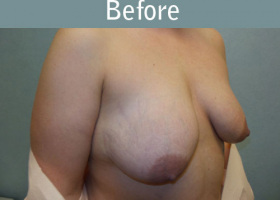 Milwaukee Plastic Surgery - Breast Lift - 23-3