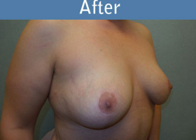 Milwaukee Plastic Surgery - Breast Lift - 23-4