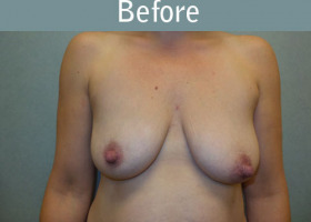 Milwaukee Plastic Surgery - Breast Lift - 24-1