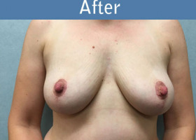 Milwaukee Plastic Surgery - Breast Lift - 24-2