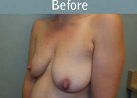 Milwaukee Plastic Surgery - Breast Lift - 24-3