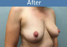 Milwaukee Plastic Surgery - Breast Lift - 24-4