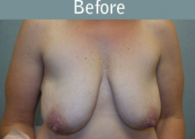 Milwaukee Plastic Surgery - Breast Lift - 25-1