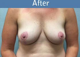 Milwaukee Plastic Surgery - Breast Lift - 25-2