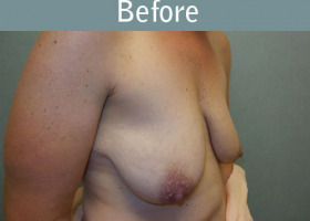 Milwaukee Plastic Surgery - Breast Lift - 25-3