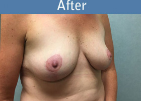 Milwaukee Plastic Surgery - Breast Lift - 25-4