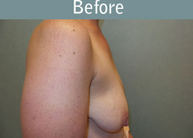 Milwaukee Plastic Surgery - Breast Lift - 25-5