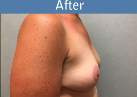 Milwaukee Plastic Surgery - Breast Lift - 25-6