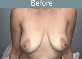 Milwaukee Plastic Surgery - Breast Lift - 26-1