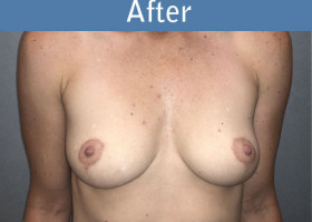 Milwaukee Plastic Surgery - Breast Lift - 26-2