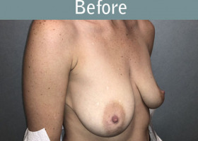 Milwaukee Plastic Surgery - Breast Lift - 26-3