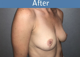 Milwaukee Plastic Surgery - Breast Lift - 26-4