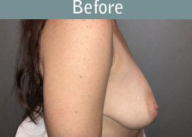 Milwaukee Plastic Surgery - Breast Lift - 26-5