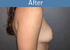 Milwaukee Plastic Surgery - Breast Lift - 26-6