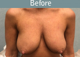 Milwaukee Plastic Surgery - Breast Augmentation - 27-1