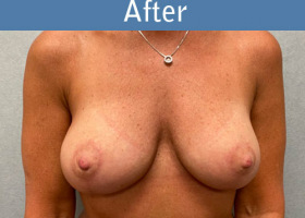 Milwaukee Plastic Surgery - Breast Augmentation - 27-2