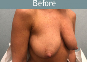 Milwaukee Plastic Surgery - Breast Augmentation - 27-3