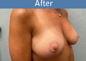 Milwaukee Plastic Surgery - Breast Augmentation - 27-4