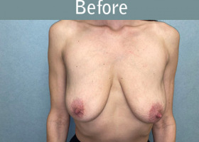 Milwaukee Plastic Surgery - Breast Augmentation - 28-1