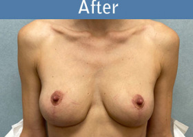 Milwaukee Plastic Surgery - Breast Augmentation - 28-2