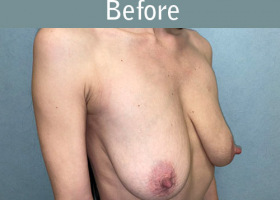 Milwaukee Plastic Surgery - Breast Augmentation - 28-3