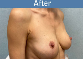 Milwaukee Plastic Surgery - Breast Augmentation - 28-4