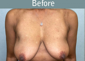 Milwaukee Plastic Surgery - Breast Augmentation - 29-1