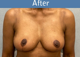Milwaukee Plastic Surgery - Breast Augmentation - 29-2