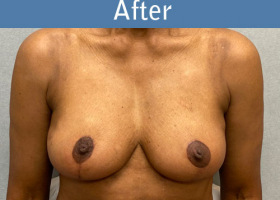 Milwaukee Plastic Surgery - Breast Augmentation - 29-2