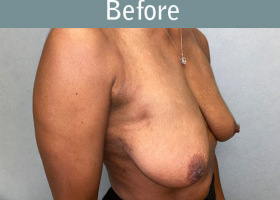 Milwaukee Plastic Surgery - Breast Augmentation - 29-3