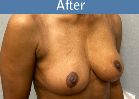 Milwaukee Plastic Surgery - Breast Augmentation - 29-4