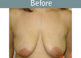 Milwaukee Plastic Surgery - Breast Lift - 04-1