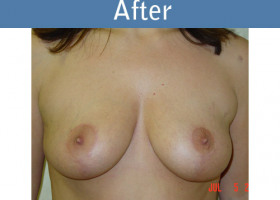 Milwaukee Plastic Surgery - Breast Lift - 04-2