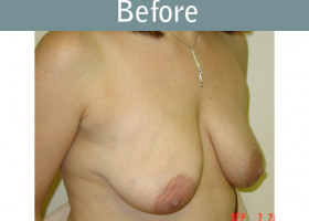 Milwaukee Plastic Surgery - Breast Lift - 05-1