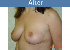 Milwaukee Plastic Surgery - Breast Lift - 05-2