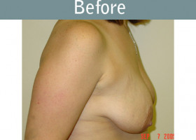 Milwaukee Plastic Surgery - Breast Lift - 06-1