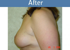 Milwaukee Plastic Surgery - Breast Lift - 06-2