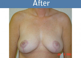 Milwaukee Plastic Surgery - Breast Lift - 07-2