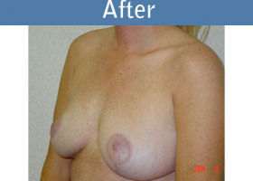 Milwaukee Plastic Surgery - Breast Lift - 08-2