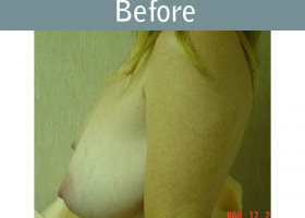 Milwaukee Plastic Surgery - Breast Lift - 09-1