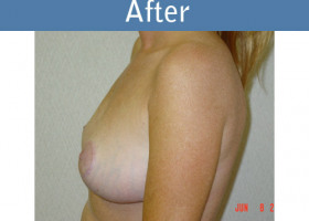 Milwaukee Plastic Surgery - Breast Lift - 09-2