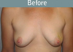 Milwaukee Plastic Surgery - Breast Reconstruction - Direct to Implant - 1-1