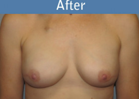 Milwaukee Plastic Surgery - Breast Reconstruction - Direct to Implant - 1-2